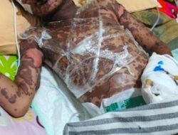 Diduga Kulit Pasien Melepuh Setelah Berobat di Puskesmas Semuli Raya Berujung Duka Mendalam Menyelimuti Kekuarga Pasien